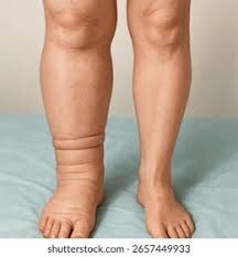 download (14) pernas pesadas com sinais de inchaço, indicando possível insuficiência venosa