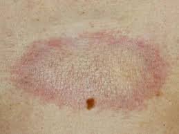 download (15) lesão clara na pele sugerindo possível câncer de pele amelanótico