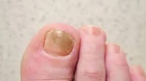 download (17) unha com fungo apresentando coloração amarelada