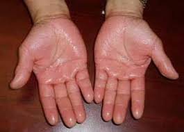 download (19) Mãos suadas com sinais de hiperidrose palmar