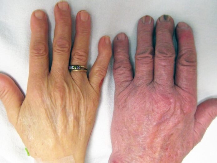 a-hand-showing-skin-paleness sinais discretos de anemia como fadiga persistente