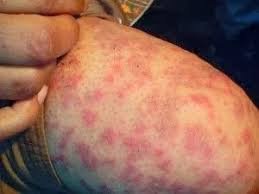 download (38) Close de pele irritada com vermelhidão e pequenas lesões