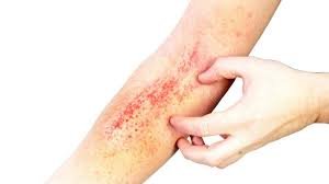 download (46) Manchas vermelhas na pele indicativas de dengue hemorrágica.