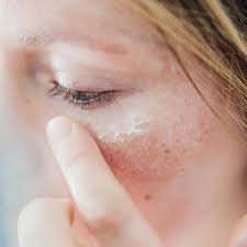 download (5) pele sensível reagindo a cosméticos