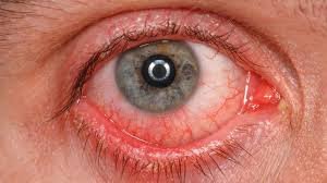 download (8) Pessoa com olhos vermelhos e cansados