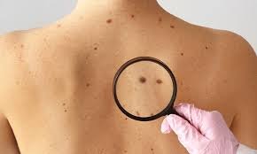 images (10) pessoa observando pintas e manchas suspeitas na pele