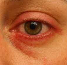 images (15) pessoa com olhos vermelhos por irritação ocular