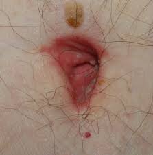 images (3) região do umbigo com sinal de desconforto.