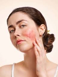 images (4) Pessoa com pele sensível apresentando vermelhidão no rosto