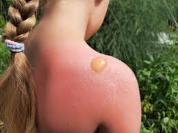 download (20) Sintomas iniciais de insolação em pessoa exposta ao calor