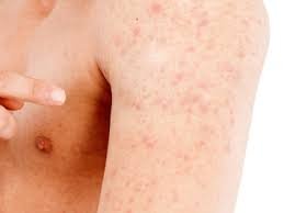 download (26) Brotoeja em adultos causada pelo calor no verão