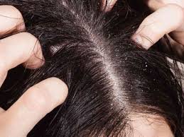 download (3) Couro Cabeludo Coçando Sem Caspa? Dermatite, Alergia ou Estresse: Descubra as Causas e o Alívio Imediato!