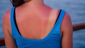 download (32) Pele avermelhada após exposição ao sol