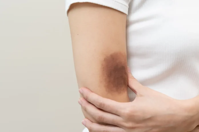 o-que-e-hematoma Mancha roxa na pele sem sinal de pancada
