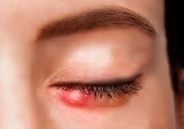 download (30) Pessoa com pálpebra inchada devido a terçol