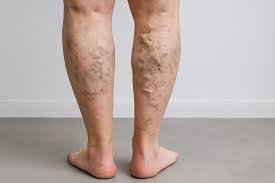 download (35) Varizes nas pernas com sinais de inchaço