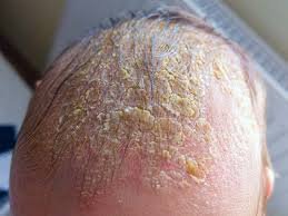 download (35) Descamação branca no couro cabeludo causada por dermatite seborreica