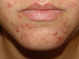 download (36) Mulher adulta com acne leve na região do queixo