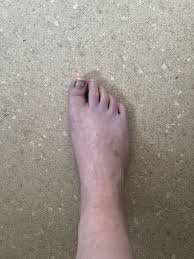 download (37) Pé frio e pálido como sinal de circulação ruim
