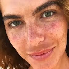 download (37) Mulher com manchas escuras simétricas no rosto características de melasma