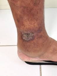 download (38) Ferida que não cicatriza na pele