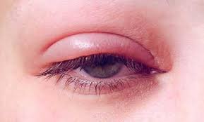 download (45) Pessoa com inchaço leve nas pálpebras ao acordar