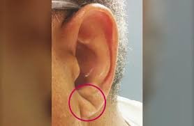 download (5) Sinal de Frank no lóbulo da orelha com dobra diagonal visível