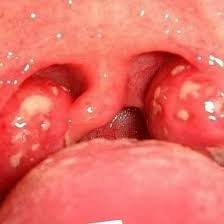 images (12) Amígdala com pequenas bolinhas brancas visíveis