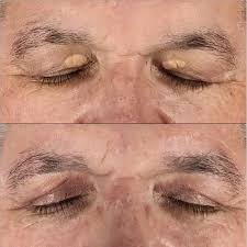 images Placas amareladas de xantelasma nas pálpebras superiores