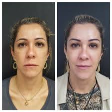 download (1) comparação antes e depois do lifting de sobrancelha