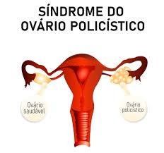 download (16) ilustração do sistema reprodutor feminino destacando ovários policísticos