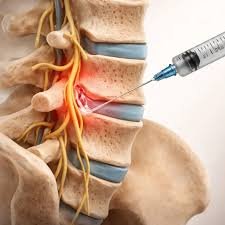 download (19) ilustração médica da coluna lombar com destaque para tratamento regenerativo