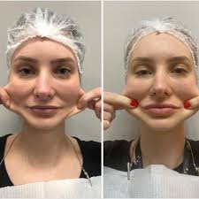 download (27) ilustração mostrando estímulo de colágeno na pele após tratamento com bioestimulador