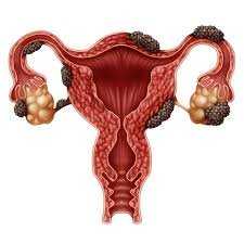 download (7) ilustração do sistema reprodutor feminino destacando áreas afetadas pela endometriose