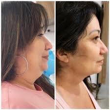 images médico cirurgião marcando região da papada antes de procedimento estético