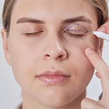 images (2) avaliação de blefaroplastia superior em pálpebras com excesso de pele