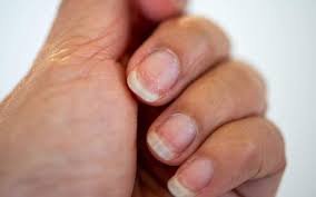 download (8) unhas quebradiças com aspecto frágil
