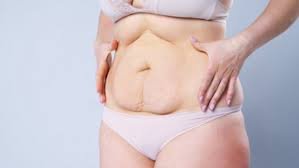 download (1) mulher diástase abdominal