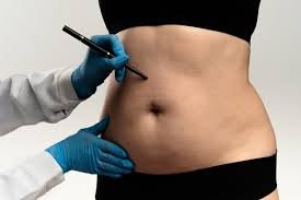 download (16) mulher analisando lipoaspiração