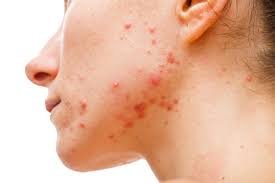 download acne adulta feminina