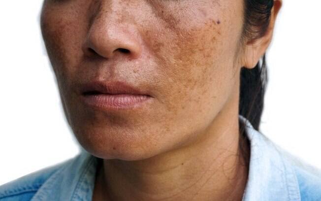 images (10) melasma