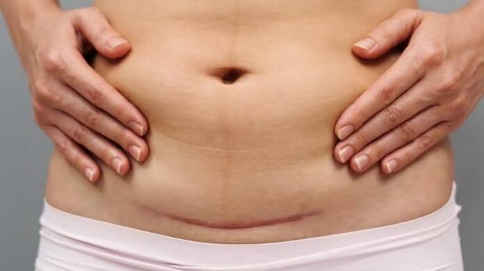images (18) Seroma após cirurgia: o que é e por que pode acontecer
