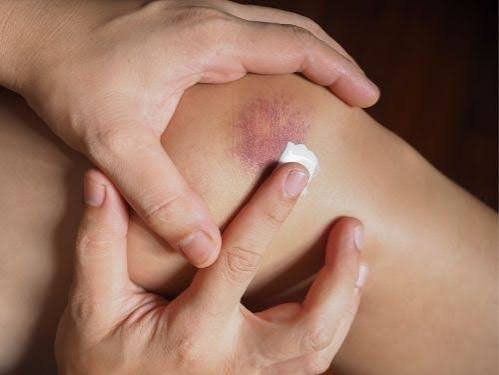 images (52) hematomas que aparecem com facilidade