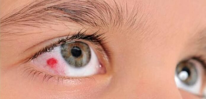 images (58) moscas volantes nos olhos