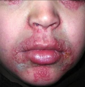 images (1) dermatite perioral