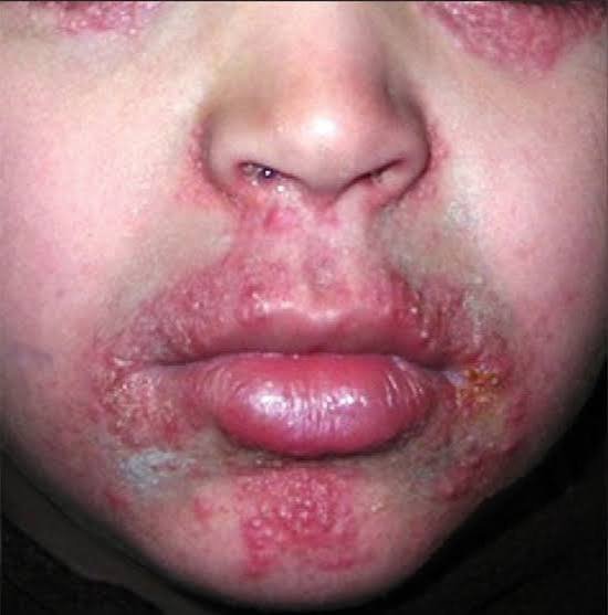 images (1) dermatite perioral