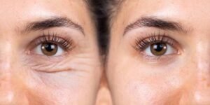 images (3) blefaroplastia inferior