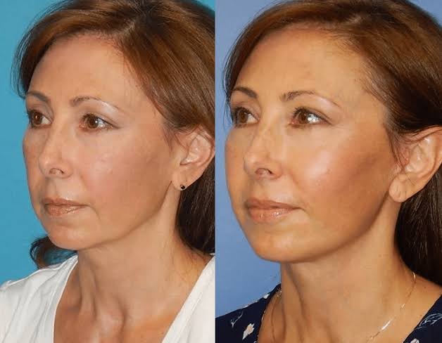 images (4) mini facelift
