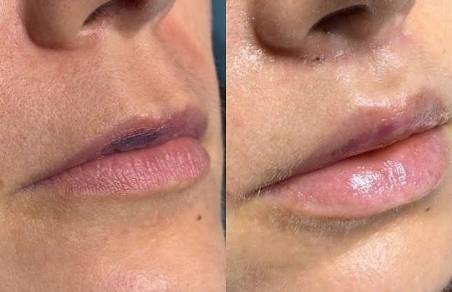 images (5) lip lift