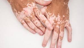 images (5) vitiligo